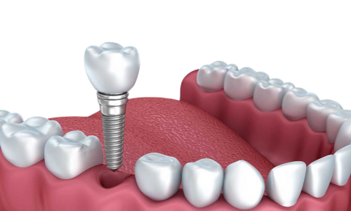 Single Dental Implant. Carmel