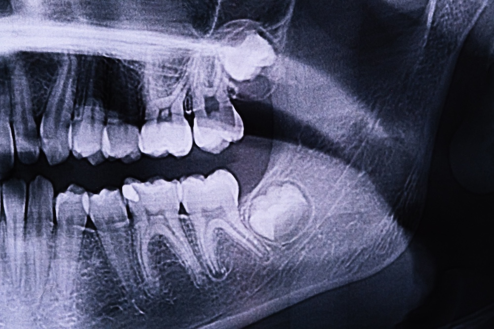 Carmel wisdom teeth extraction