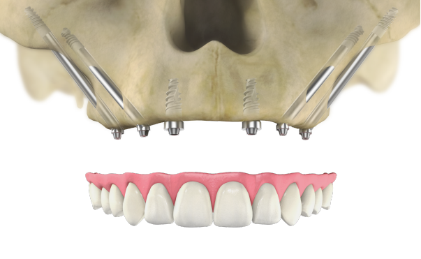 Dental Implants for Patients with No Bone
